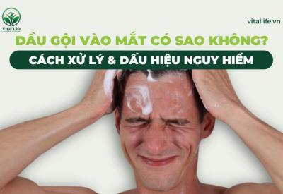 Dầu Gội Vào Mắt Có Sao Không? Cách Xử Lý & Dấu Hiệu Nguy Hiểm