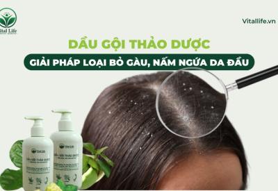 Dầu Gội Thảo Dược: Giải Pháp Loại Bỏ Gàu, Nấm Ngứa Da Đầu