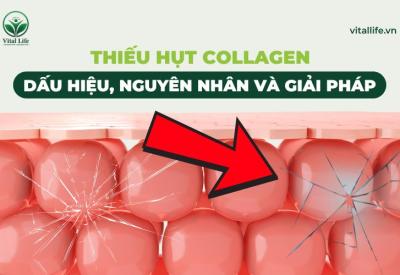 Thiếu Hụt Collagen: Dấu Hiệu, Nguyên Nhân Và Giải Pháp