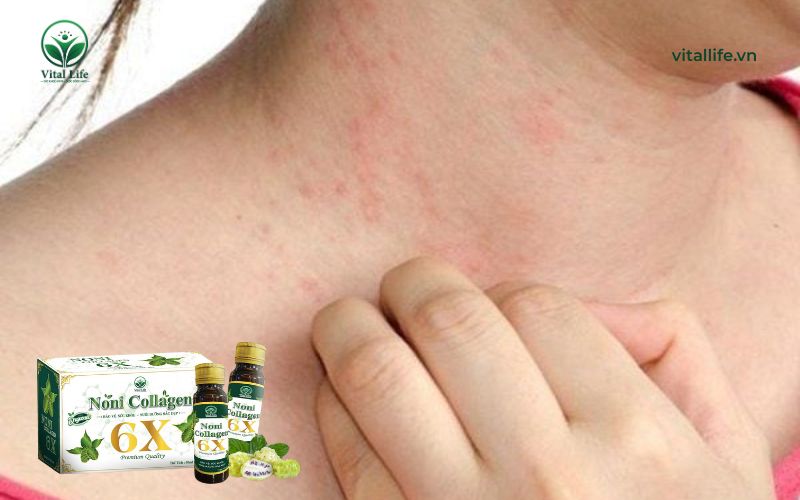 Dừng uống Collagen ngay nếu da bạn nổi mẩn, ngứa