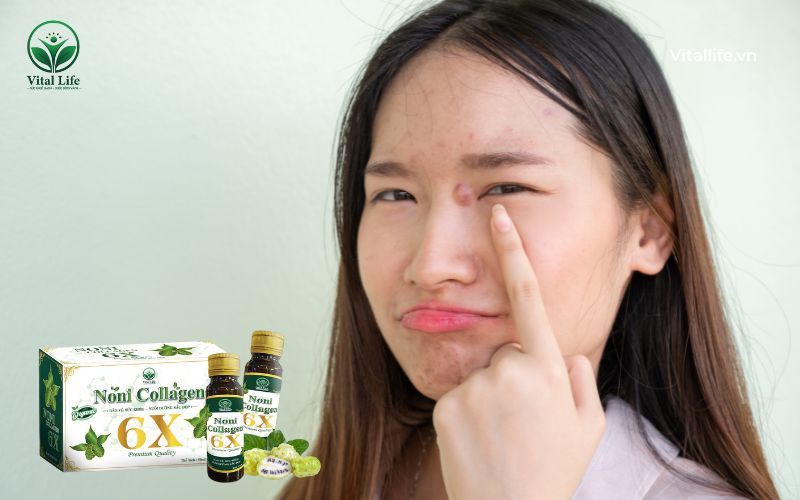 Nguyên nhân khiến uống collagen bị nổi mụn