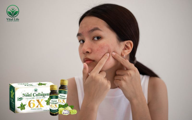 Uống collagen bị nổi mụn có thể là do không đúng liều lượng