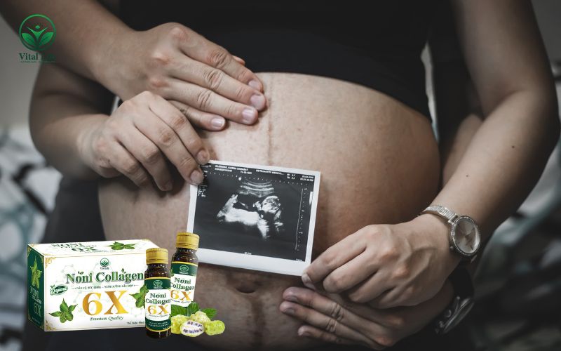 Bổ sung Collagen giúp hỗ trợ cải thiện cấu trúc da và phòng ngừa rạn da