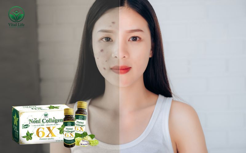 Cách xử lý khi uống collagen bị nổi mụn
