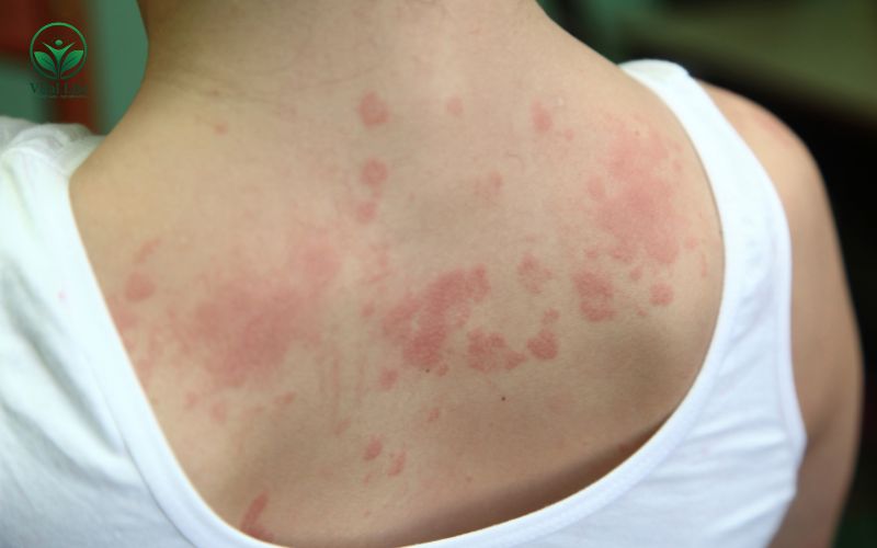Phản ứng dị ứng khi uống Collagen ở một số người